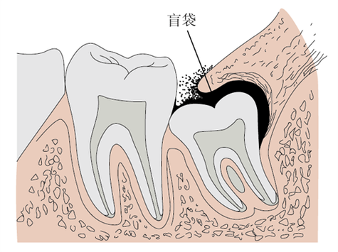 【健康科普】刷到“夺命牙痛”？当心是智齿在拉警报！