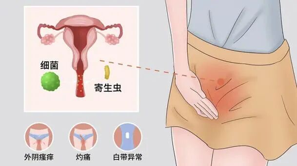 【健康科普】痒痒痒！但这痒不能乱抓——中医专家教您如何应对“外阴瘙痒”