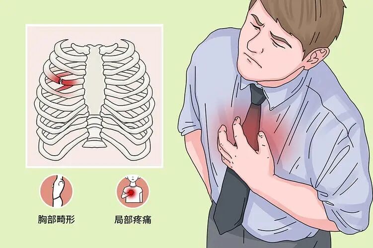 【健康科普】肋骨骨折：一种让你“不敢深呼吸”的伤