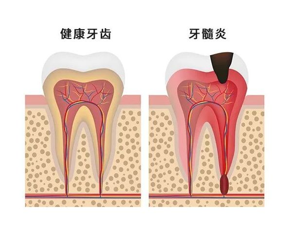 【健康科普】牙齿里的“隐形危机”，别等疼了才后悔！